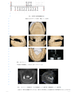 インプラントボーンアンカード
