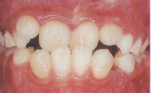 受け口　反対咬合