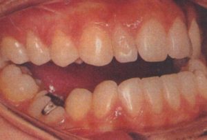 受け口　反対咬合