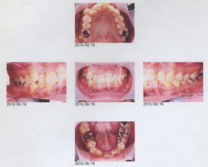 ビーバー　上顎前突