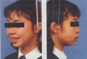 矯正治療　上顎前突