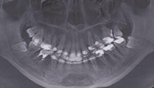 ビーバー　上顎前突