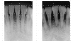 下顎前歯のレントゲン
