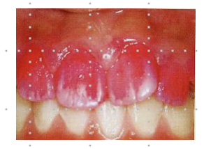 プラークの染め出し