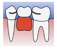 義歯