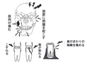 歯軋り 噛み締め