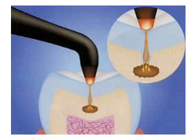 ダイアグノデント