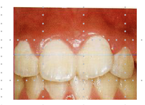 炎症のある歯肉