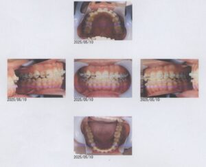 矯正するのに抜歯するかで悩んでいる20代女性
