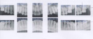 矯正中に歯がしみる?