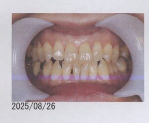 右下ブリッジが噛むと痛い50代女性