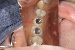 Blue Radical Periodontal Disease Treatment Device