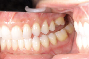 Teeth tilting during orthodontic treatment, tooth sensitivity
