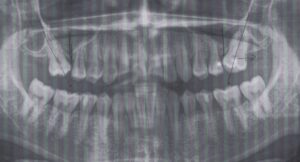 矯正中に歯がしみる?