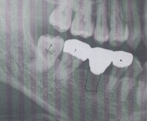 右下ブリッジが噛むと痛い50代女性