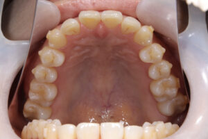 Invisalign correction failure