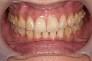 Invisalign failure - Gum recession