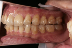 Invisalign failure - Gum recession1