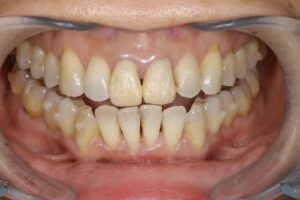 Invisalign correction failure