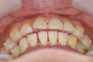 Invisalign failed orthodontic treatment