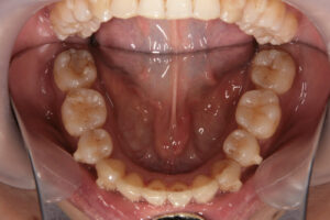 Invisalign failure - Gum recession