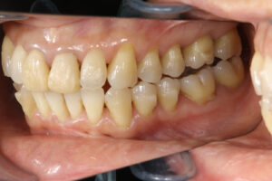 Invisalign correction failure