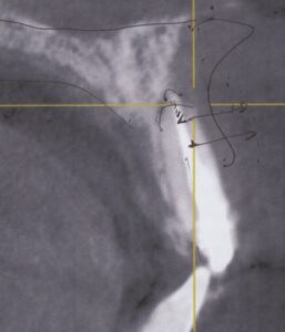 インビザラインで失敗した４５歳女性