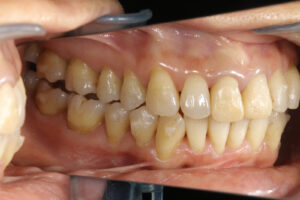 Invisalign correction failure