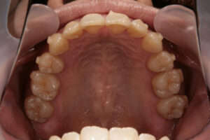 Invisalign failure - Gum recession