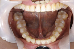 Invisalign correction failure
