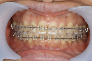 orthodontic treatment