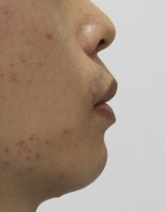 Invisalign orthodontics failed