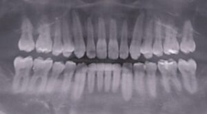 他院のインビザラインで失敗した３３歳男性