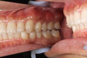 Invisalign orthodontics failed