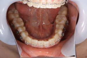 Invisalign wire orthodontics