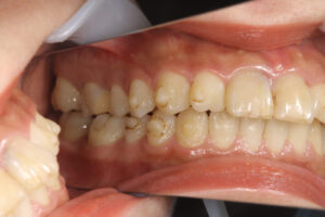 Invisalign wire orthodontics half-lingual