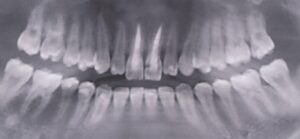 インビザラインで失敗した23歳女性