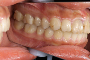 wire orthodontics half-lingual