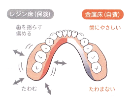 自費の入れ歯