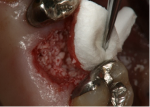 抜歯創用保護剤　　　　　　　 