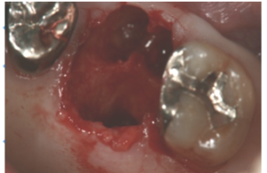 ソケットプリザベーション