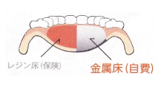 自費の入れ歯