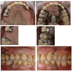構造設計の義歯
