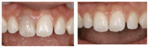 図6 22 歳女性 術前術後の口腔内写真