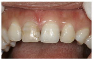 図１ 初診時の口腔内写真24 歳 女性