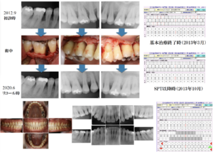 最新SPT時（6年8ヵ月経過）の口腔内写真・エックス線写真・歯周組織検査　（2020年6月）