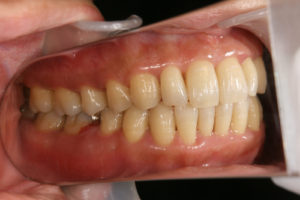 Bleeding from lower right 