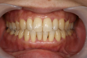 Bleeding gums