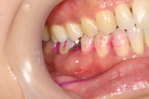 Dyeing of unpolished areas