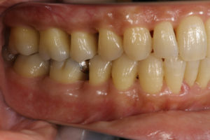 Improved gums